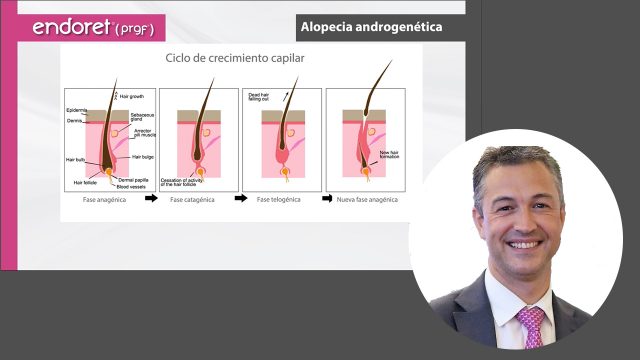 🇪🇸  PRGF – ENDORET® en el tratamiento capilar