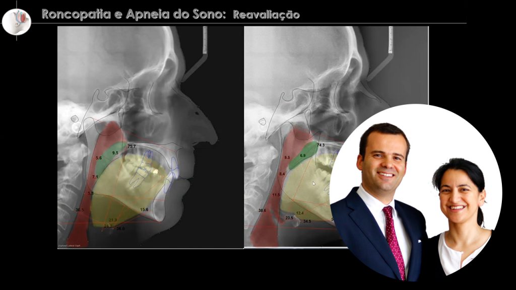 Apneia: sinais e sintomas - Ordem dos Médicos Dentistas