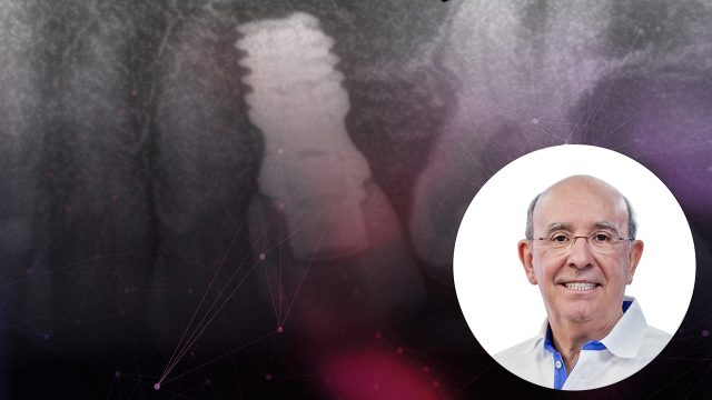 🇩🇪 Extra kurze Implantate in der Einzelzahnversorgung