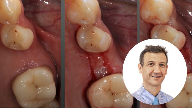 🇮🇹 Rivisitazione del trattamento del mascellare atrofico
