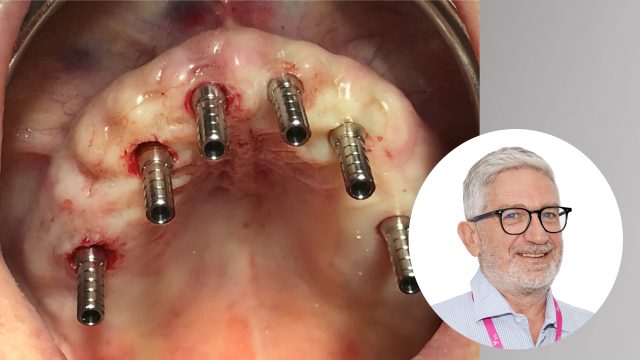 🇮🇹 Il piano di trattamento implantoprotesico nel paziente con patologie sistemiche