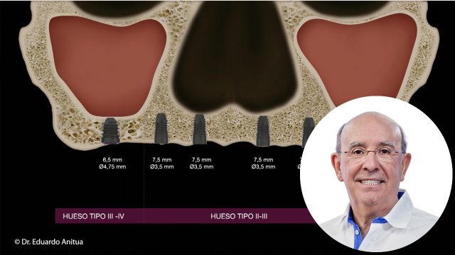 🇪🇸 Abordaje del maxilar superior extremadamente reabsorbido