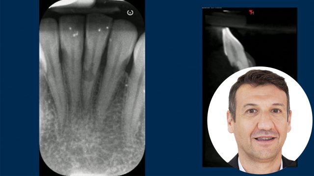 🇮🇹 Sostituzione di dente singolo in area estetica con impianti BTI 3.0