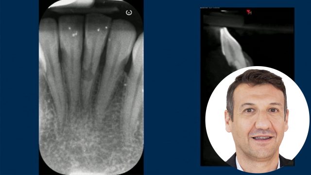 🇬🇧 Single tooth replacement in the estetic area with 3.0 BTI Implants