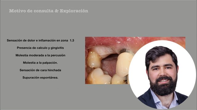 🇪🇸 Casos clínicos: rehabilitación maxilar