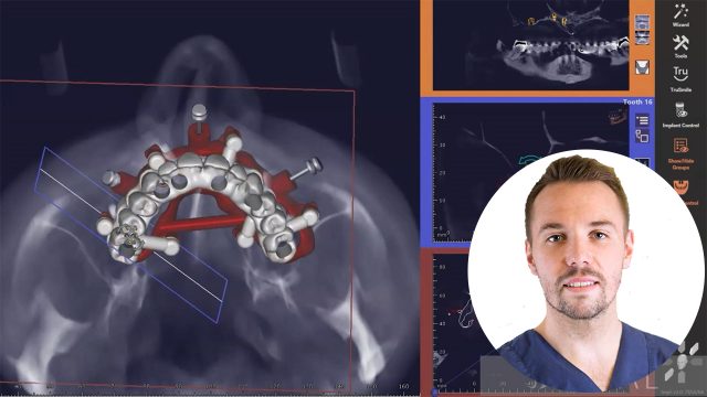 🇭🇷 Nadograđujuća kirurška vodilica sa Bti implantatima