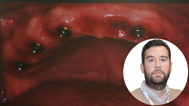 🇪🇸 Casos Clínicos: Restauración dental integral en un caso complejo