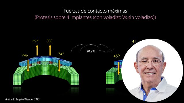 🇪🇸 Tratamiento del desdentado total inferior